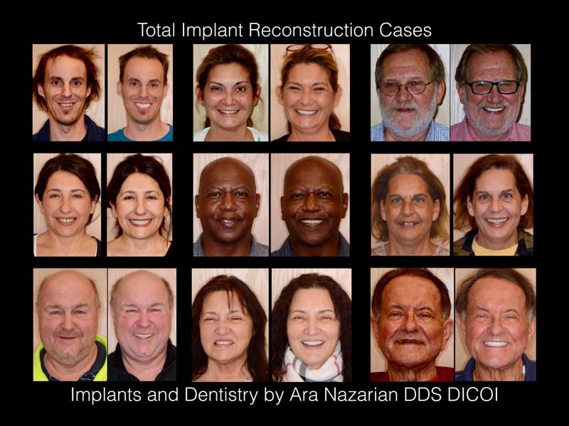 all on 4 dental implants results Shelby Township mi