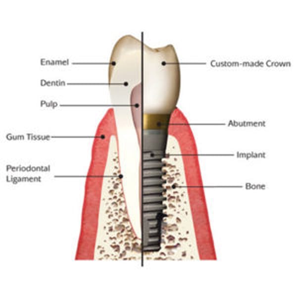 Shelby Township Dental Implant Dentist