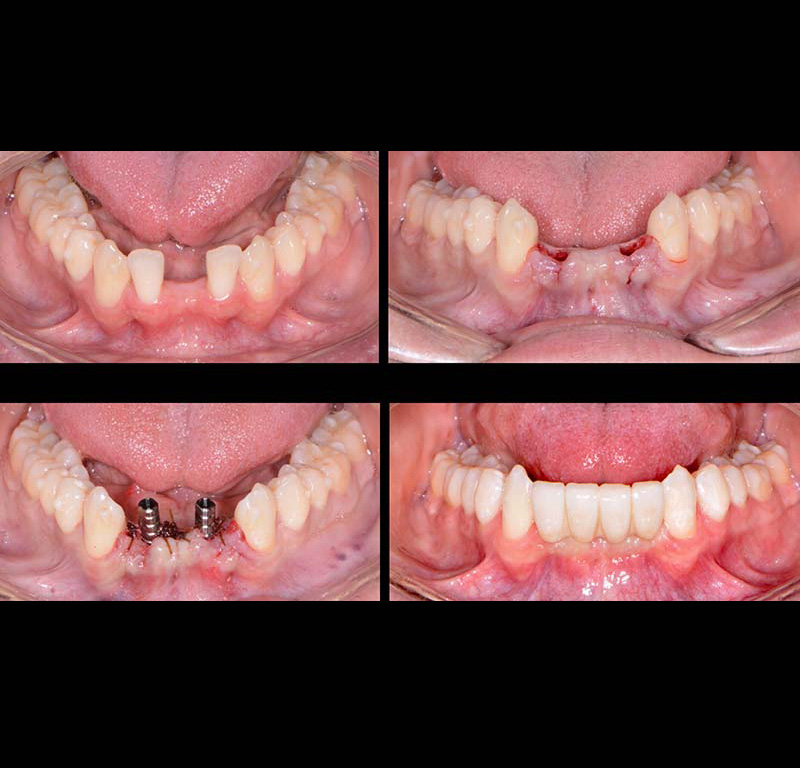 Before After Dental Bridges Shelby Township MI