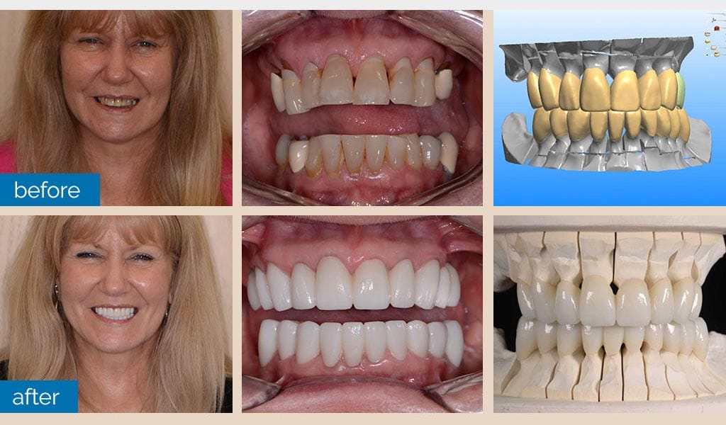 Crowns Implants Dentist Shelby Township Mi 1
