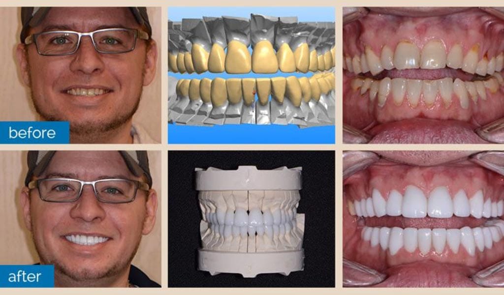 Crowns Implants Dentist Shelby Township Mi 3