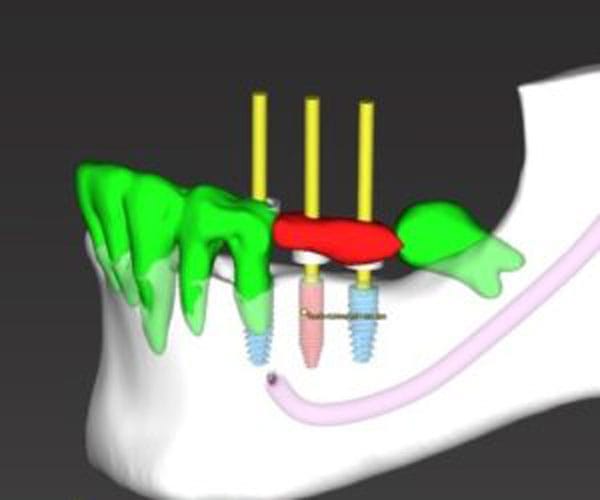 Dental Implant Dentist Shelby Township Mi 16