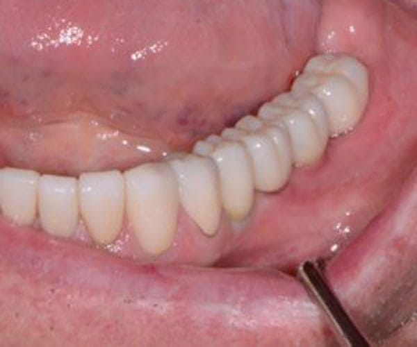 Dental Implant Dentist Shelby Township Mi 18