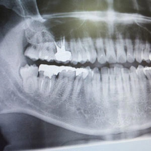 Dental Implant Dentist Shelby Township MI