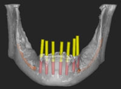 Dental Implant Dentist Shelby Township Mi 8