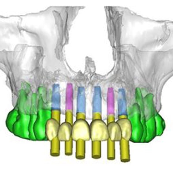 Dental Technology Dentist Shelby Township MI Implant Planning Software