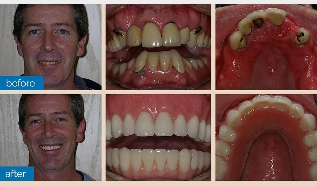 Dentures Dentist Shelby Township Mi 1
