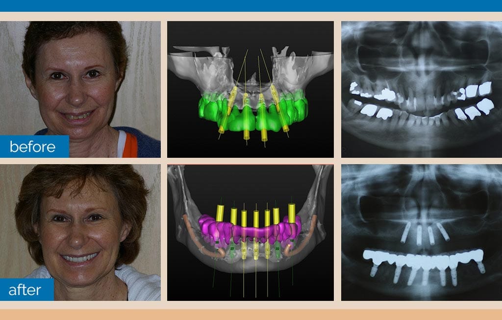 Dental Implants Dentist Shelby Township, MI