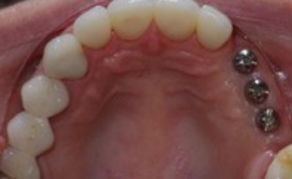 Implant Dentist Shelby Township Mi 1