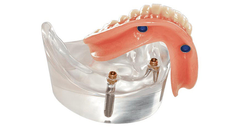 Implant Supported Dentures Shelby Township MI
