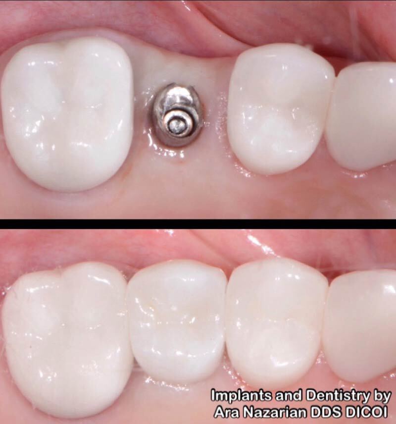 Receive Dental Implants Shelby Township Mi