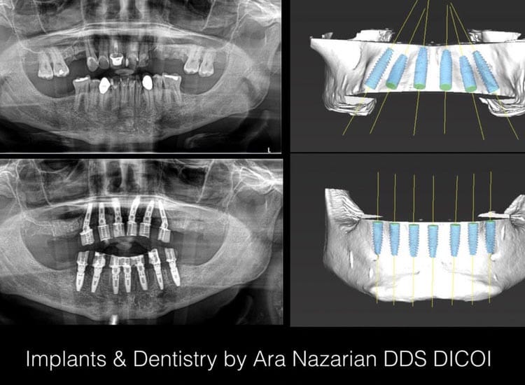 Shelby Township Implant Dentist 1