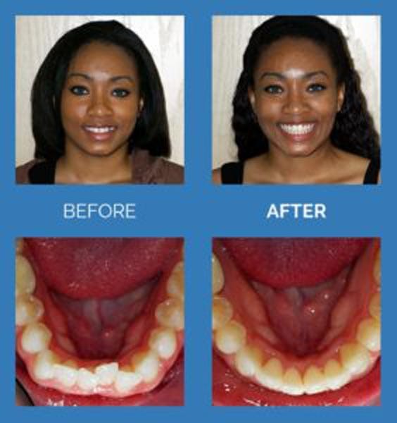 Shelby Township Mi Rapid Orthodontics Dentist