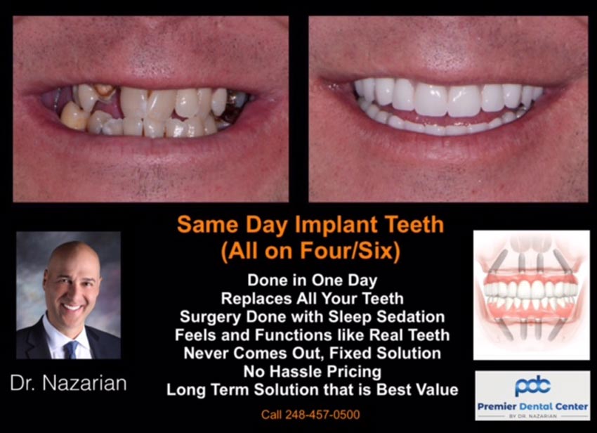 Who Can Benefit From All On 4 Implants Shelby Township Mi
