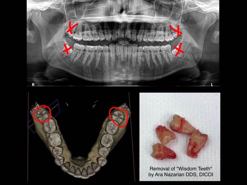 Wisdom Teeth Removal Shelby Township Mi