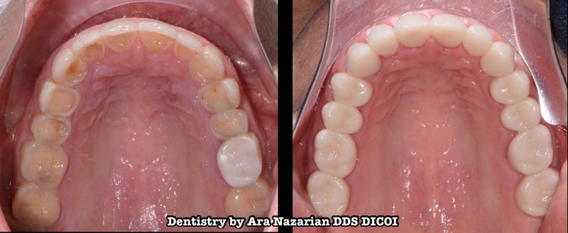 Zirconia Dental Restoration Shelby Township MI
