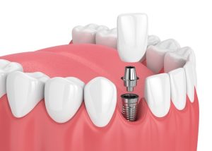 Dental Implant Diagram