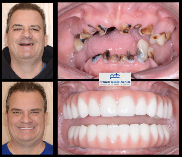 Total Mouth Reconstruction Near Michigan