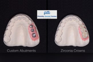 Cam Cad Dental Implant Dentist Shelby Township Mi 325x217