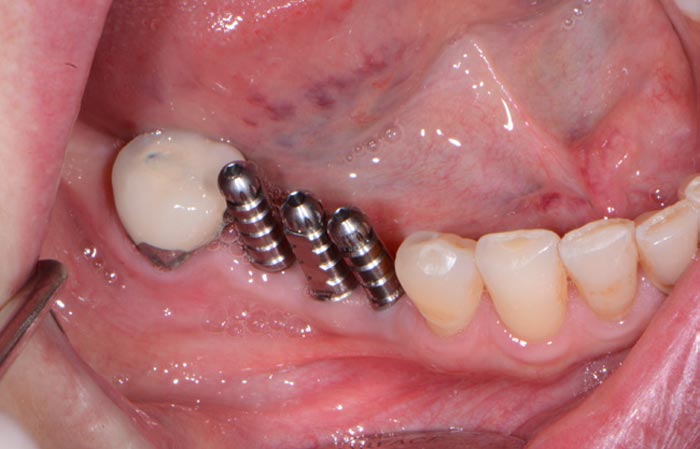 Dental Implant Placement Dentist Shelby Township Mi 2