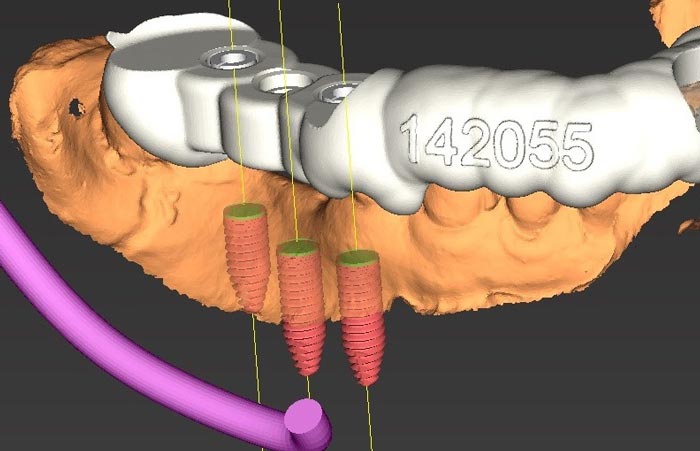 Dental Implant Placement Dentist Shelby Township