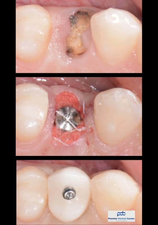 Dental Implants Closeup