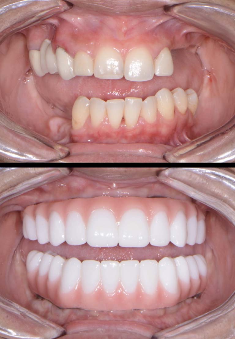 Full Mouth Reconstructions