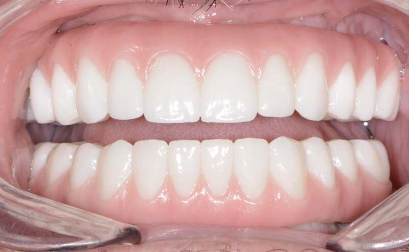 Hybrid Dental Implants Results