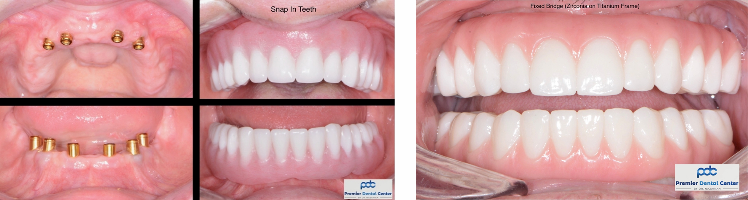 Prosthetic Perfect Implant Placement Grand Rapids Mi