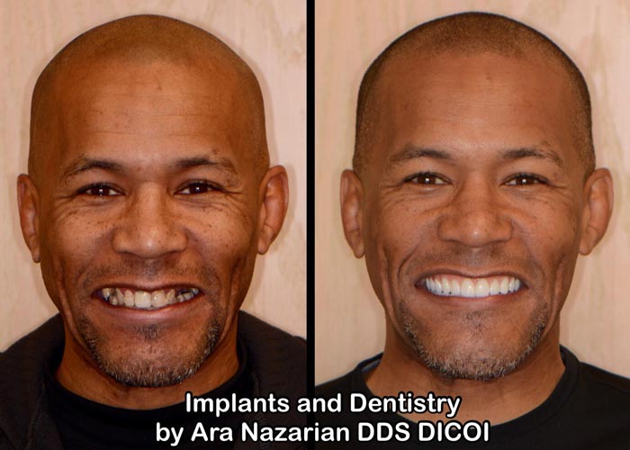 Shelby Township Mi Dental Implant All On Four Dentist (1)