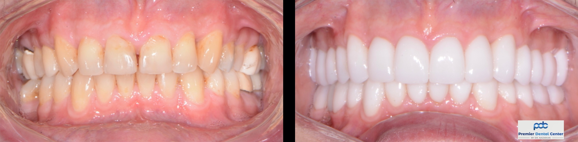 Zirconia Crowns Grand Rapids